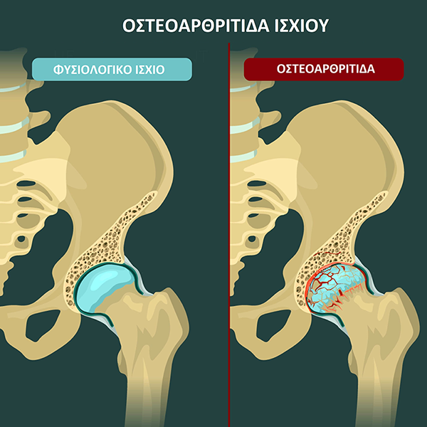 osteoarthritida-isxiou