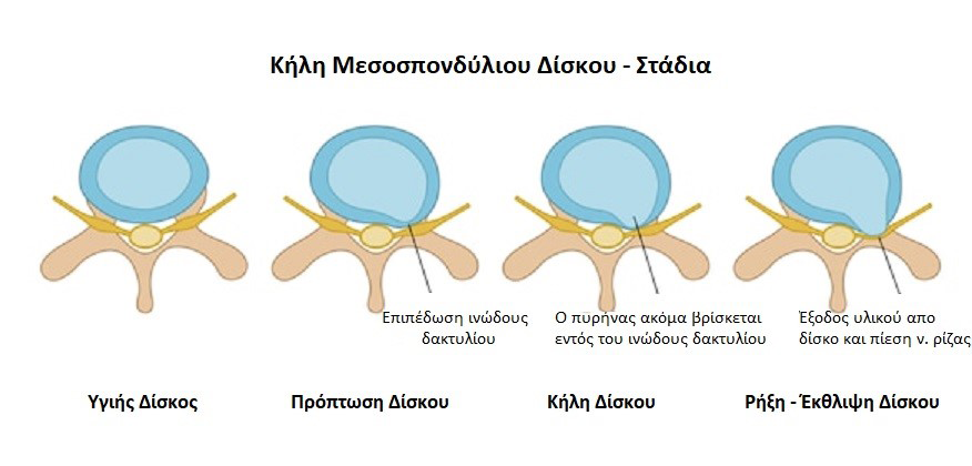 kili-mesospondyliou-diskou